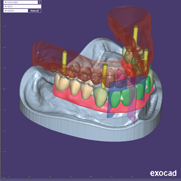 3DSolutions - EXOCAD Dental CAD