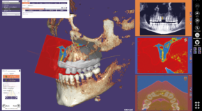 produit Logiciels EXOCAD Dental CAD