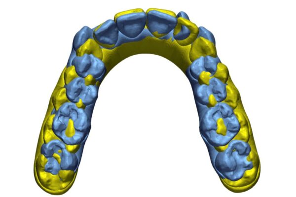 Geomagic Control X aide à faire avancer les traitements orthodontiques